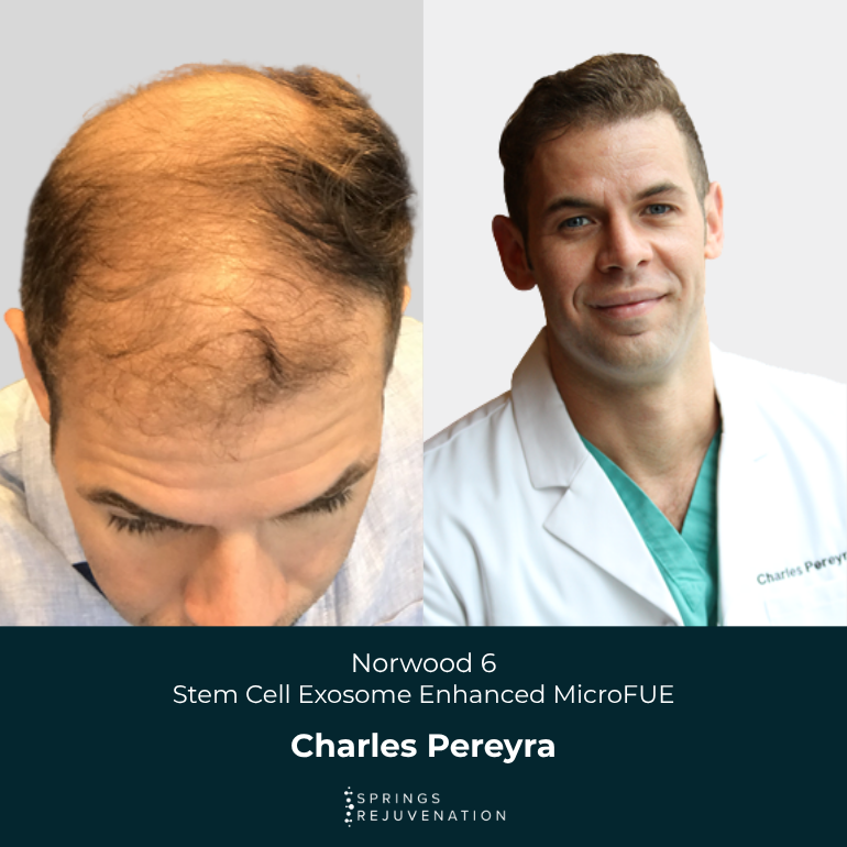Charles P. - Before & After